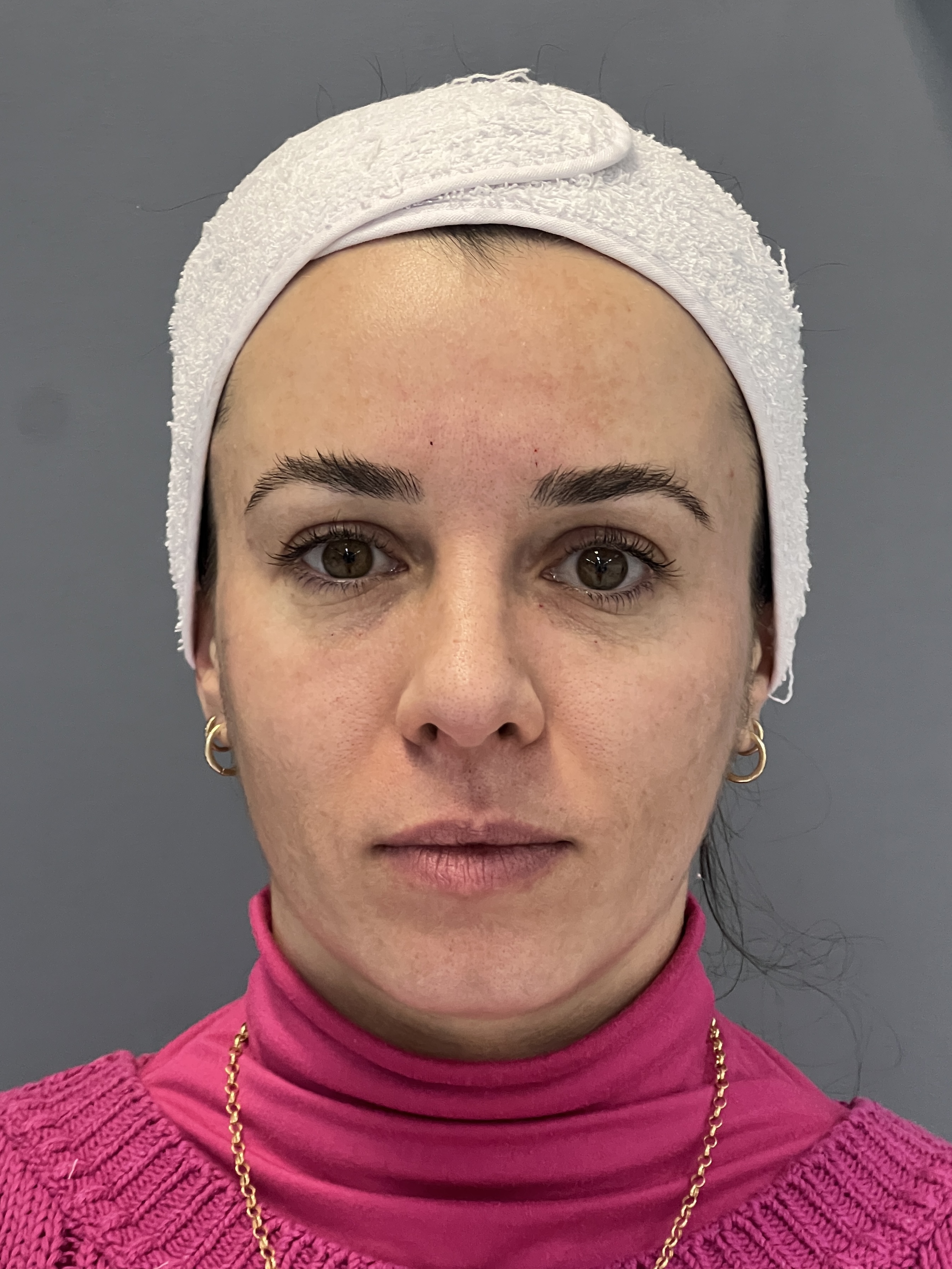 Fer depois do preenchimento de olheiras + bioestímulo de colágeno